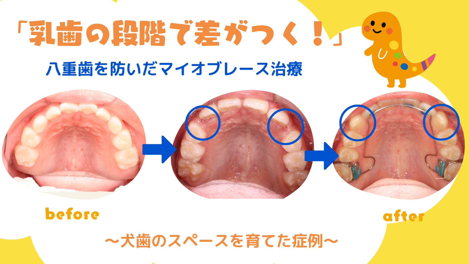 「乳歯の段階で差がつく! 八重歯を防いだマイオブレース治療」 〜犬歯のスペースを育てた症例〜
