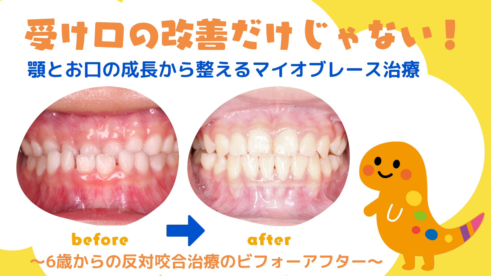 受け口の改善だけじゃない! 顎とお口の成長から整えるマイオブレース治療 〜6歳からの反対咬合治療のビフォーアフター〜