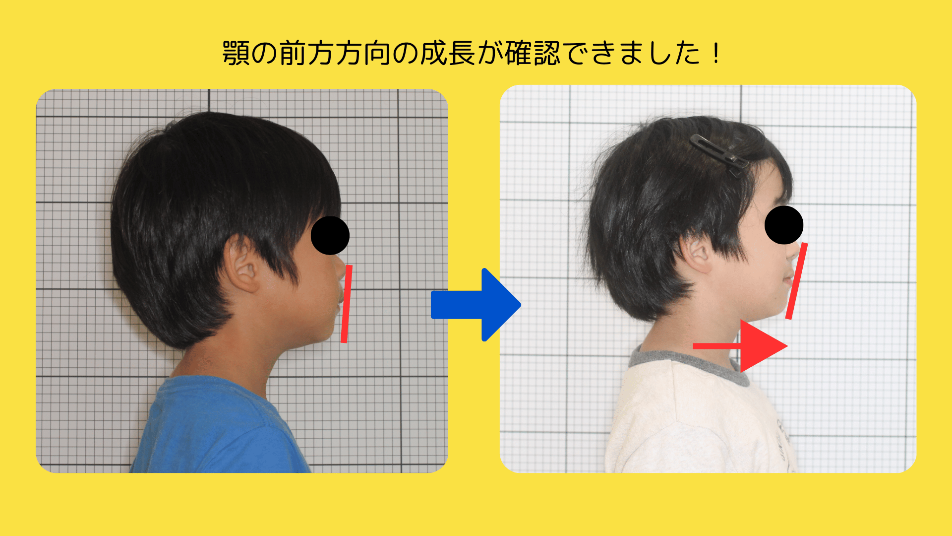 「歯並び」も「顔つき」も変わる! 成長を活かしたマイオブレース治療 〜6歳から始めたガタガタ改善と顔の発育〜