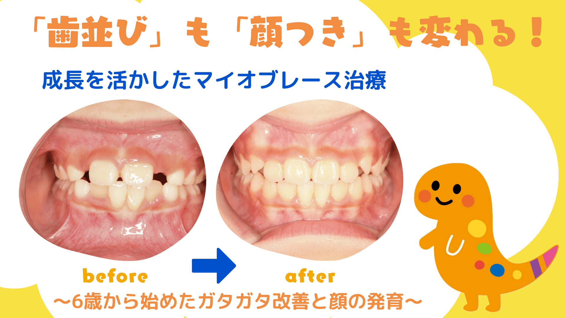 「歯並び」も「顔つき」も変わる! 成長を活かしたマイオブレース治療 〜6歳から始めたガタガタ改善と顔の発育〜