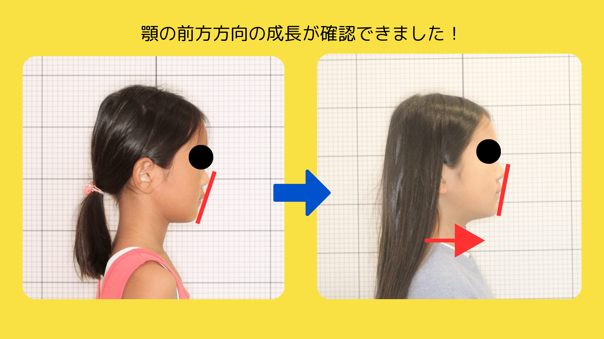 噛み合わせのズレは成長のサイン 上顎の狭さと左右差を整えるマイオブレース治療 〜噛み合わせが気になると相談に来られたお子さんの症例〜